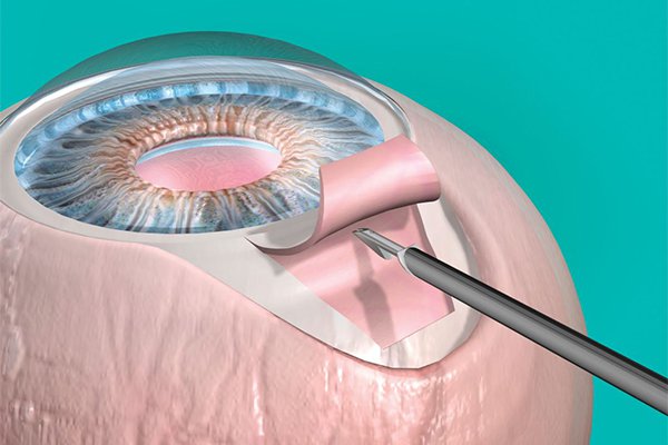 Glaucoma