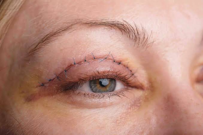 Blefaroplastia